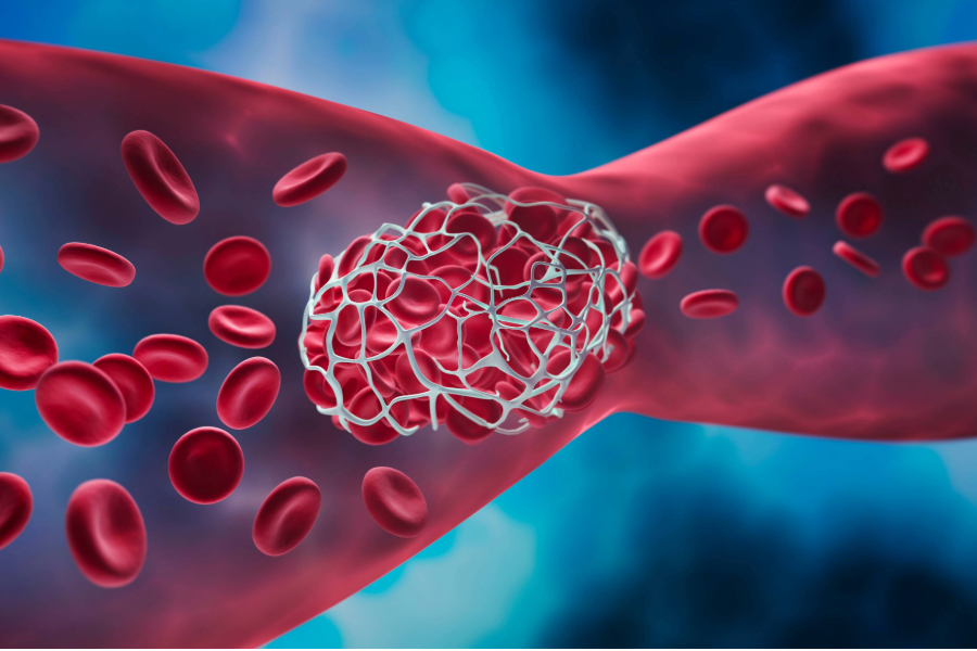 blood clot deep vein thrombosis